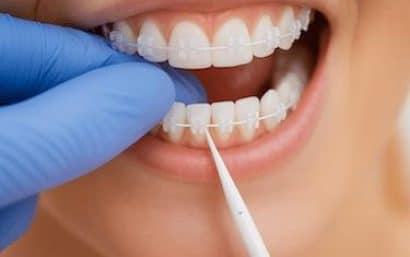 Ajuste de brackets de zafiro con arco blanco en revisión de ortodoncia estética