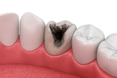 Tratamiento de conducto por caries profunda para eliminar infección y conservar el diente