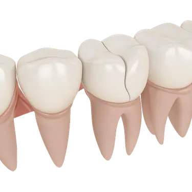 Diente fracturado tratado con técnicas de odontología conservadora en Madrid