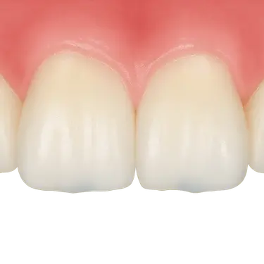 Dientes desgastados por bruxismo tratados con reconstrucción dental conservadora en Madrid