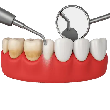 Limpieza dental profesional en Madrid para eliminar sarro y prevenir enfermedades de las encías