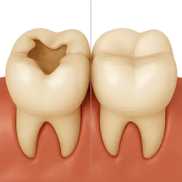 Reconstrucción dental con resina compuesta en Madrid tras caries o fracturas severas