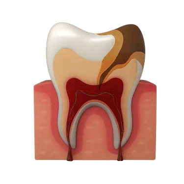 Tratamiento conservador de recubrimiento pulpar para proteger la pulpa dental en Madrid