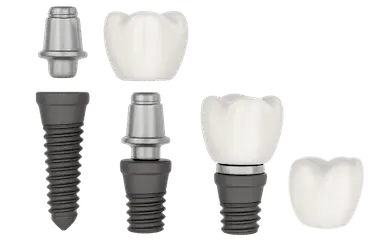 Tratamientos de implantología en Murcia con opciones de implantes, puentes y prótesis