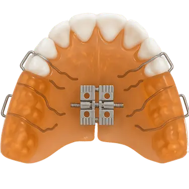 Twin Block en modelos dentales para adelantar la mandíbula en ortodoncia infantil