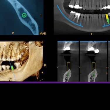 Estudio radiográfico para planificar implantes dentales en Madrid con tecnología 3D