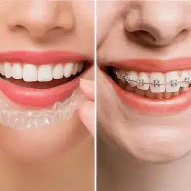 Colocación de ortodoncia con alineadores transparentes y brackets metálicos en Madrid