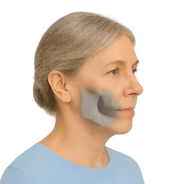 Mujer con pérdida ósea maxilar, caso indicado para dentadura parcial removible