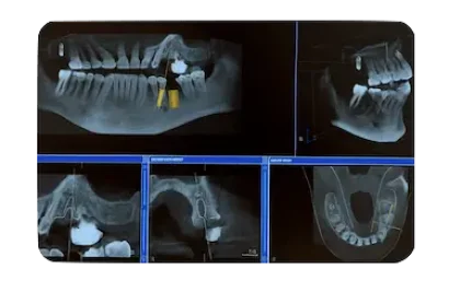 Radiografías digitales para planificar implantes dentales de carga inmediata en clínica de Murcia