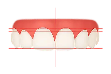 Contorneado dental en Murcia para mejorar la estética y alineación de los dientes por Dr. Ferrer