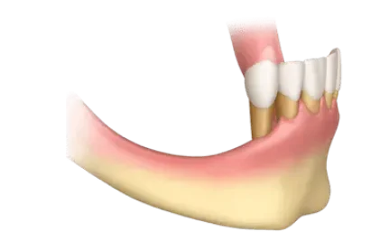 Falta de hueso en mandíbula inferior para colocar implantes dentales en Murcia, caso Dr. Ferrer