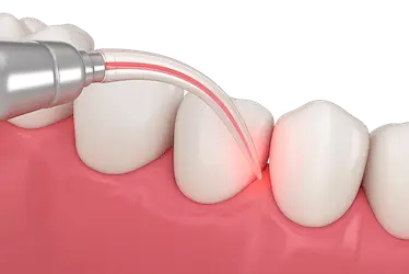 Limpieza dental profesional en Murcia para eliminar placa y cuidar la salud de las encías