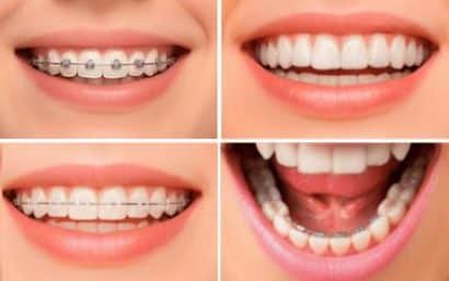 Sonrisas con brackets y ortodoncia invisible en pacientes de la Clínica Dr. Ferrer en Madrid