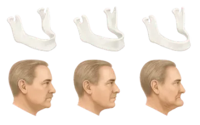 Secuencia de reabsorción ósea mandibular tras pérdida dental y su efecto en el perfil facial
