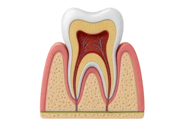 Esquema dental del recubrimiento pulpar conservador para proteger la pulpa del diente