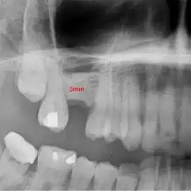 Radiografía con pérdida ósea maxilar para planificar injerto óseo previo a implante