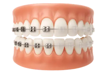 Modelo 3D con brackets metálicos y estéticos en ortodoncia en Clínica Dental Medics Madrid