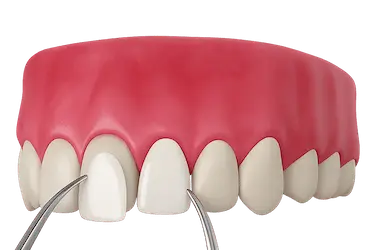 Tratamiento de estética dental con carilla en Murcia realizado por el Dr. Ferrer