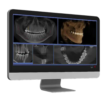 Planificación 3D para valoración de implante dental con injerto de hueso y membrana en Madrid