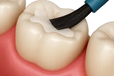 Colocación de sellador dental en diente infantil para prevenir caries en Clínica Dr. Ferrer Madrid