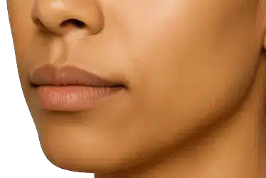 Rostro femenino tras bichectomía estética en Murcia mostrando el contorno facial