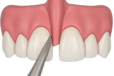 Frenectomía labial con técnica mínimamente invasiva en la Clínica Dental Dr. Ferrer en Murcia