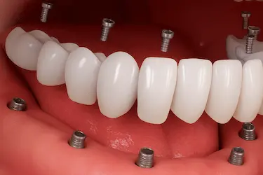 Prótesis dental inmediata atornillada sobre implantes con técnica de carga inmediata en Murcia