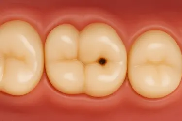 Caries en molar infantil tratada con empaste dental en Clínica Dental Medics Dr. Ferrer en Madrid