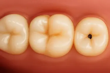 Tratamiento de caries en niños con empaste dental en Clínica Dental Medics Dr. Ferrer Murcia