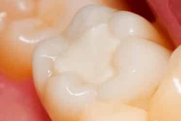 Empaste dental estético de resina del color del diente en Clínica Dental Dr. Ferrer Murcia