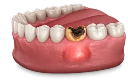 Exodoncia en Murcia por diente infectado con caries profunda