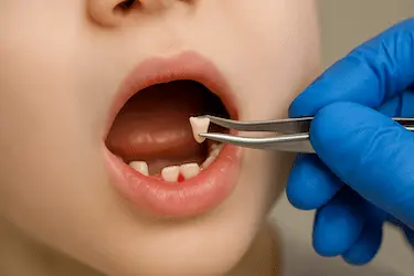Odontopediatra realizando extracción de diente de leche en niño en Clínica Dental Medics Madrid