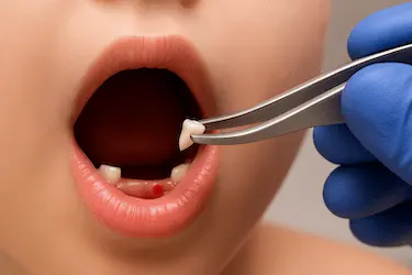 Extracción dental infantil en Murcia con pinzas odontológicas en Clínica Dental Medics Dr. Ferrer