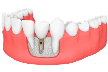 Visualización de injerto de hueso dental en clínica Dr. Ferrer Madrid con implante integrado