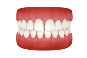 Maloclusión dental con mordida cruzada antes de ortodoncia en Madrid.