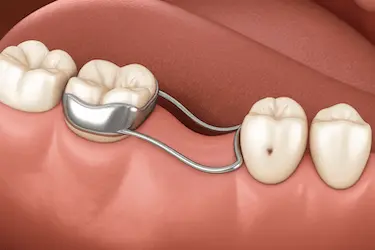 Mantenedor de espacio fijo infantil para evitar desplazamientos dentales en Madrid
