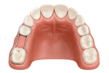 Mantenedor de espacio infantil superior tras pérdida dental en Clínica Dr. Ferrer Murcia