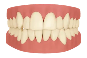 Dientes torcidos con apiñamiento antes de un tratamiento de ortodoncia en Madrid