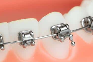 Tratamiento de ortodoncia con brackets autoligables en Madrid en la clínica dental del Dr. Ferrer