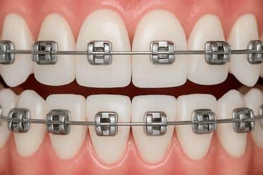 Ortodoncia en Madrid con Dr. Ferrer y brackets metálicos en dientes superiores e inferiores