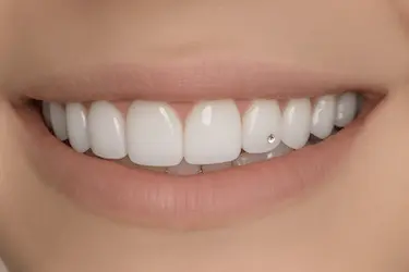 Piercing dental con brillante en diente superior en Clínica Dental Dr. Ferrer en Murcia
