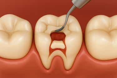 Pulpotomía en diente de leche para eliminar pulpa dañada y conservar la pieza infantil