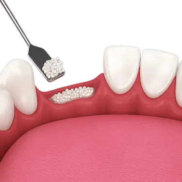 Ilustración 3D de injerto de hueso dental en encía superior previo a implante