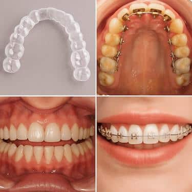 Ejemplos de ortodoncia con alineadores transparentes y brackets metálicos y estéticos