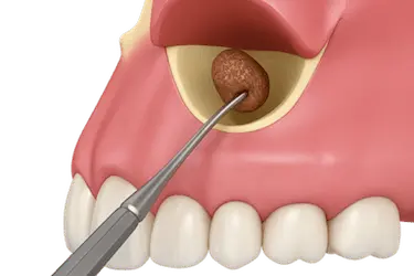 Quistectomía oral en Murcia para eliminar lesiones del hueso maxilar en Clínica Dr. Ferrer