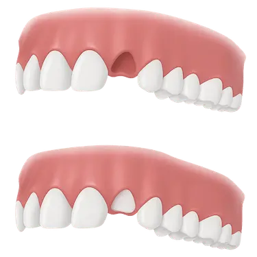 Ilustración 3D de pérdida de hueso dental que requiere injerto óseo previo a implantes