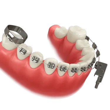 Retirada de ortodoncia con brackets sobre una arcada dental en clínica dental de Madrid