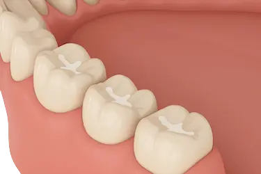 Selladores en dientes de leche tras revisión infantil en Clínica Dr. Ferrer Murcia