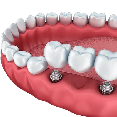Puente dental de tres coronas sobre dos implantes dentales en la arcada inferior en Murcia