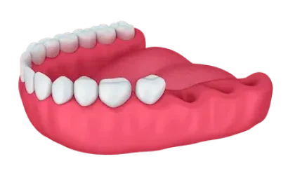 Tratamiento con puente sobre implantes en Murcia para recuperar varias piezas dentales perdidas